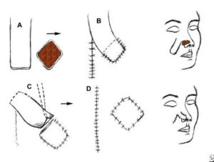 Coding guidelines for Tissue Transfer or Rearrangement 