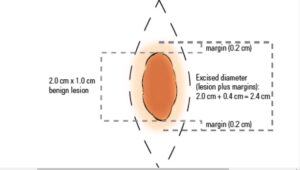 How to calculate excision of skin lesion?