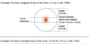 Coding guidelines for Excision of skin lesion