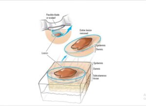 Skin Biopsy coding guidelines