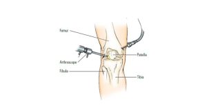 Coding guidelines for Arthroscopy knee