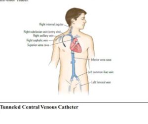 CPT Coding guidelines of Central Venous Access procedure