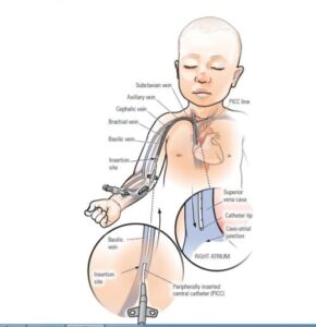 CPT Coding guidelines of Central Venous Access procedure