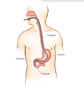 Endoscopic Retrograde Cholangiopancreatography